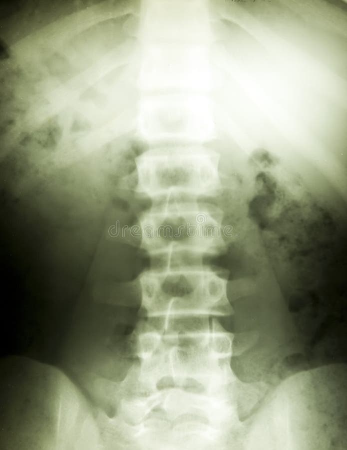 X ray pic with spine. X ray pic with spine