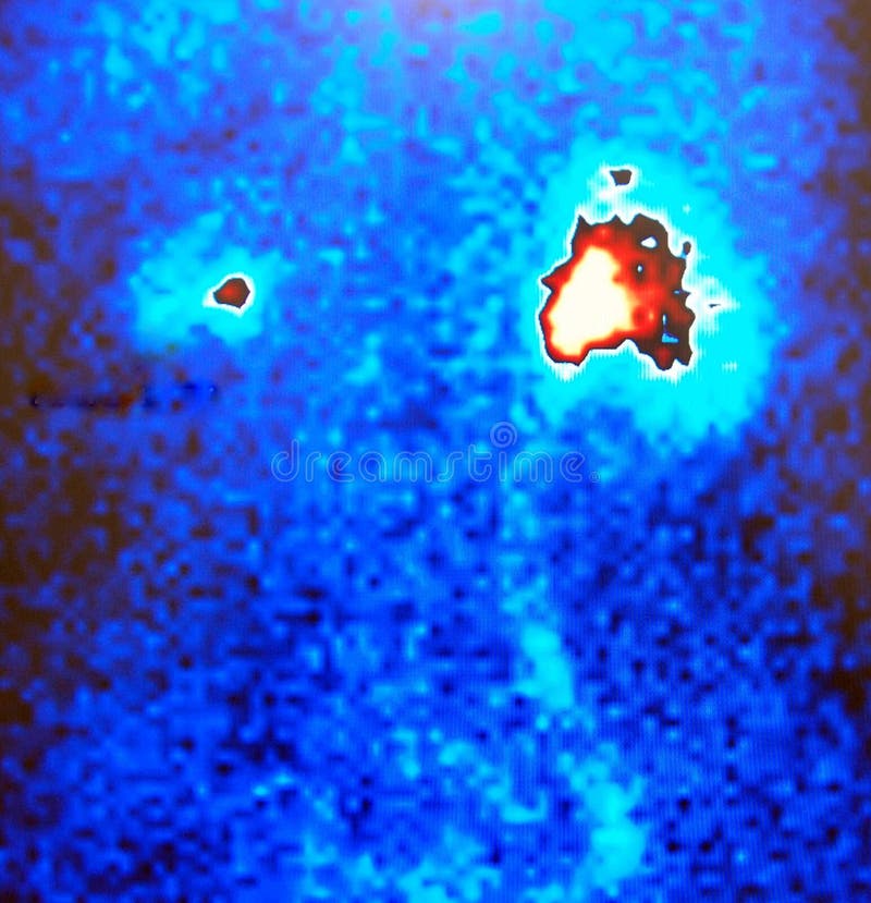 Atrophic kidney pathology reveals on the renal nuclear scan ,image without annotations arrow and marks ,one kidney with normal function. Atrophic kidney pathology reveals on the renal nuclear scan ,image without annotations arrow and marks ,one kidney with normal function