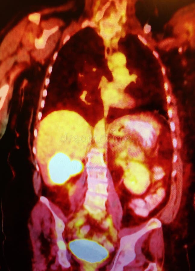 PET/CT tomography scan revealed about 9 cm heterogeneous mass within the right lobe of the liver . On the image its looks like white spot in the middle of the body, in the area of yellow liver. PET/CT tomography scan revealed about 9 cm heterogeneous mass within the right lobe of the liver . On the image its looks like white spot in the middle of the body, in the area of yellow liver.