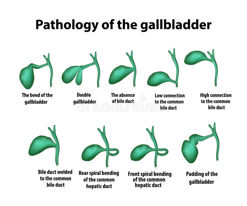Gallbladder 9 Types