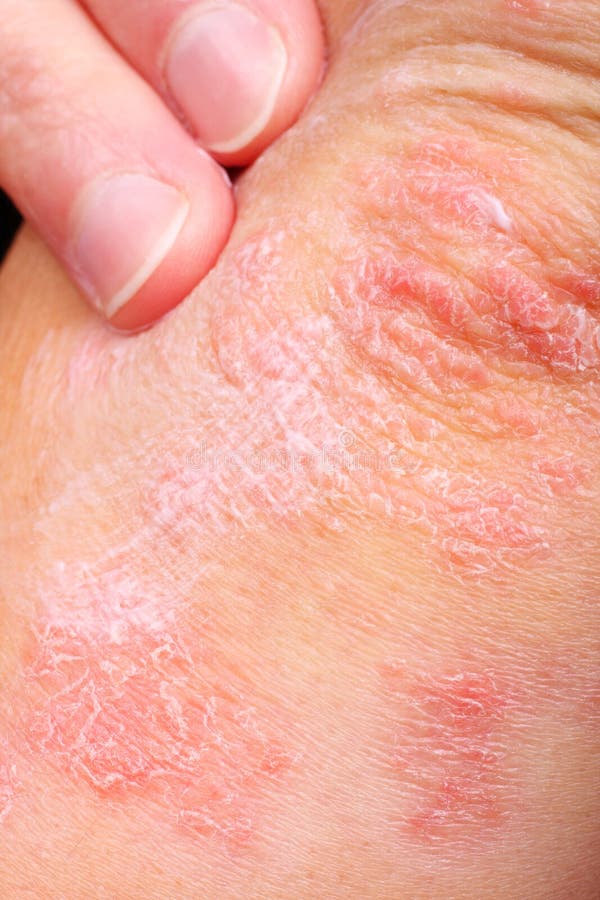 Patient mit Psoriasis lizenzfreies stockbild Patient mit Psoriasis lizenzfreies stockbild