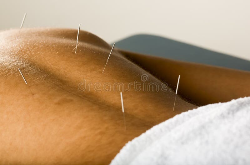 Patient mâle d'acuponcture photographie stock libre de droits Patient mâle d'acuponcture photographie stock libre de droits