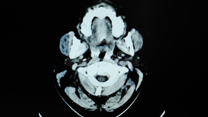 Patienter med cerebral blödning i stroke.