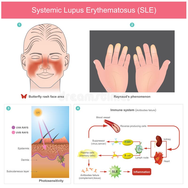 Как выглядит системная красная волчанка Systemic Lupus Erythematosus SLE. the Patients Skin Inflammation from the Light.