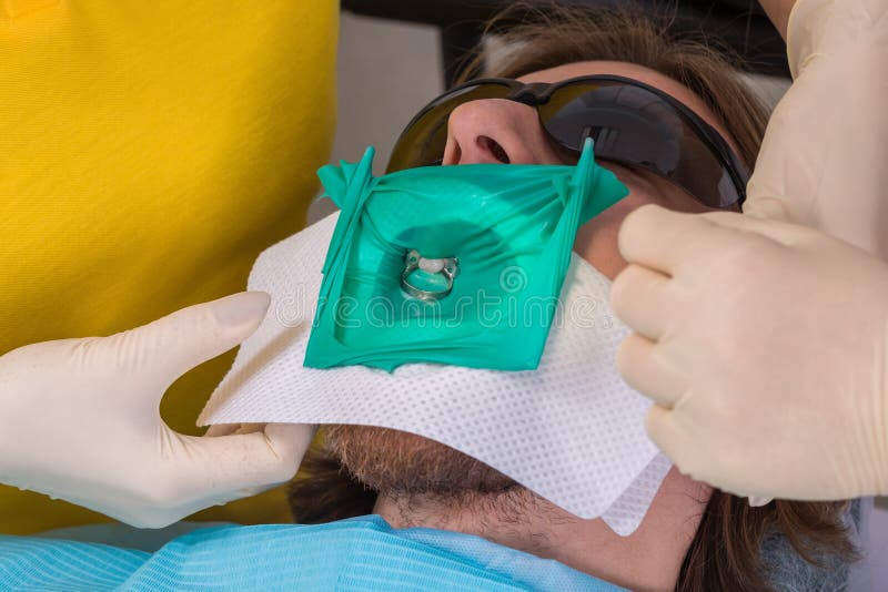 Patiënt die tandbehandeling krijgen op tandartskantoor met tand rubberdambescherming en de slimme klem van het matrijssysteem, di stock afbeelding Patiënt die tandbehandeling krijgen op tandartskantoor met tand rubberdambescherming en de slimme klem van het matrijssysteem, di stock afbeelding