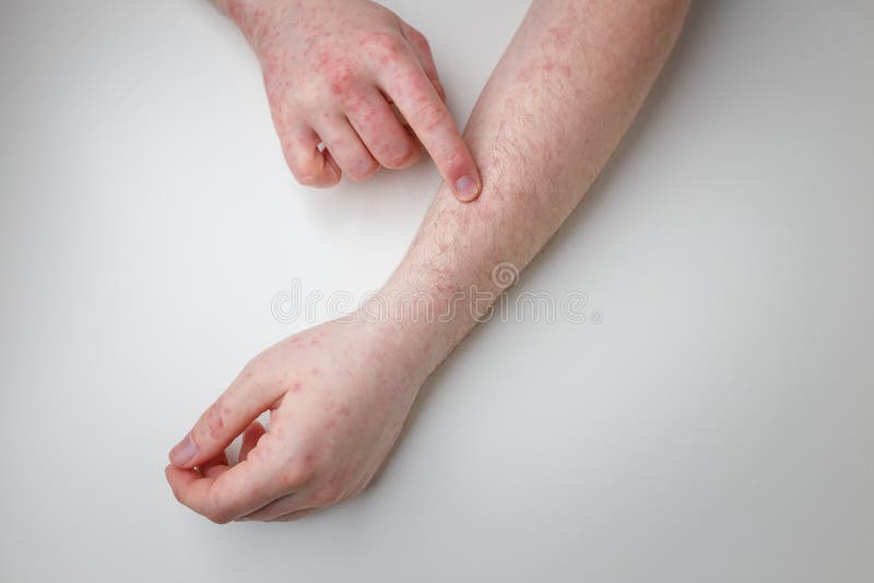 Paziente Con Prurito Rosso Sulle Mani E Sulle Braccia Dermatite Eczema
