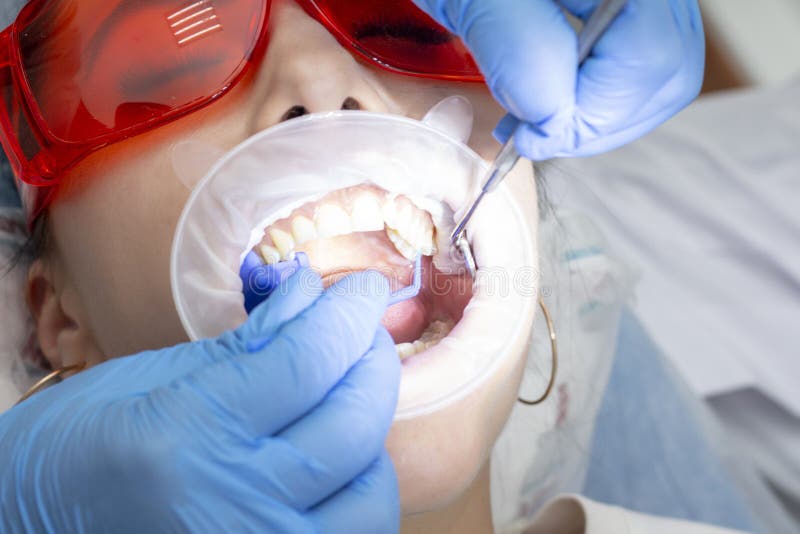 Paziente della ragazza alla ricezione al trattamento del dentista del dente cariato la ragazza si trova sulla sedia dentaria con fotografia stock libera da diritti Paziente della ragazza alla ricezione al trattamento del dentista del dente cariato la ragazza si trova sulla sedia dentaria con fotografia stock libera da diritti