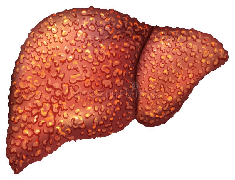 Pazienti del fegato con epatite Il fegato è persona malata Cirrosi di fegato Alcolismo di ripercussione illustrazione di stock Pazienti del fegato con epatite Il fegato è persona malata Cirrosi di fegato Alcolismo di ripercussione illustrazione di stock