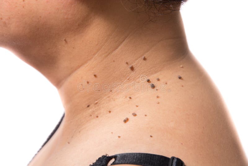 Peau d'une femme avec des taupes photographie stock libre de droits Peau d'une femme avec des taupes photographie stock libre de droits