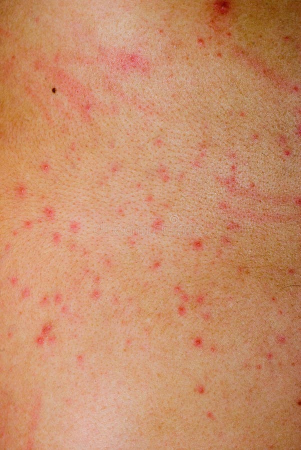 Peau Impétueuse Allergique D'eczema De Dermatite Sur La Jambe Du Patient Peau De Psoriasis Et D