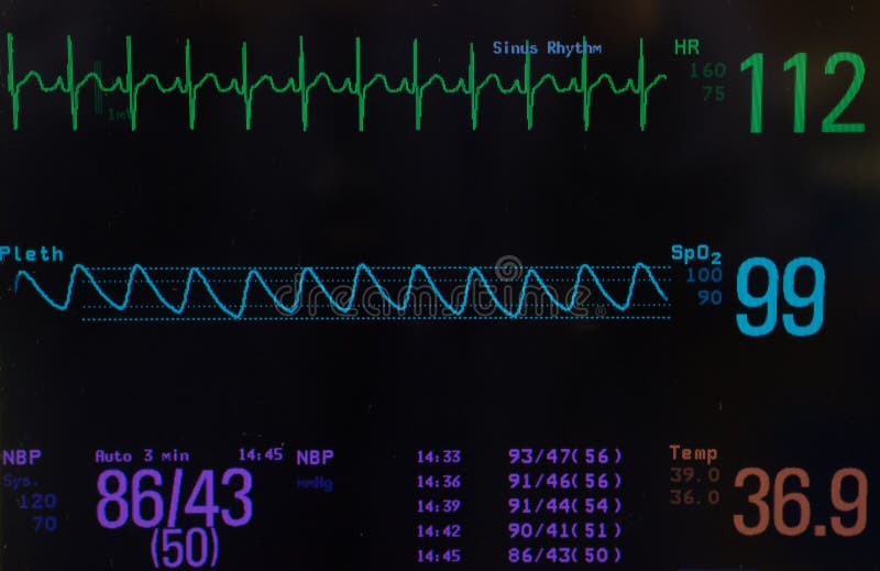 Close up of a monitor with a black screen with the EKG or electrocardiogram showing normal sinus rhythm green line, oxygen saturation blue line , blood pressure and temperature of a pediatric patient. Close up of a monitor with a black screen with the EKG or electrocardiogram showing normal sinus rhythm green line, oxygen saturation blue line , blood pressure and temperature of a pediatric patient.