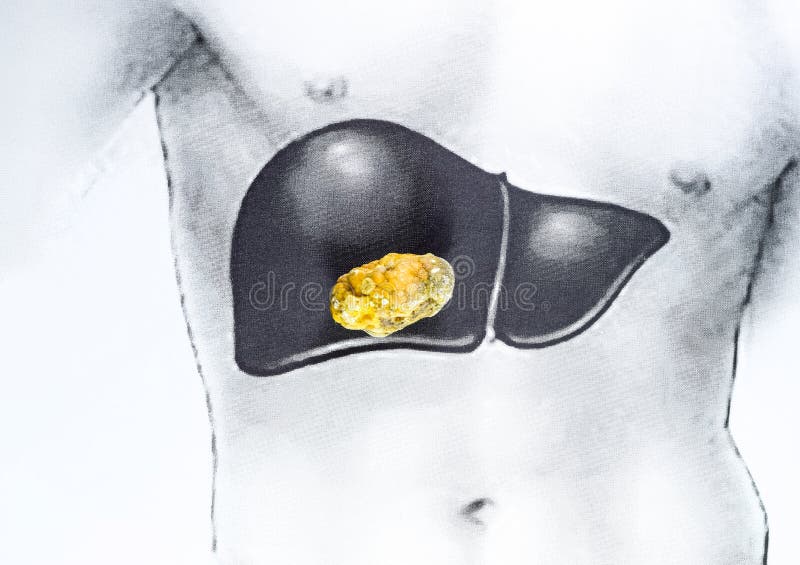 Fígado Frito Com Cebola E Tomate Sobre Fundo De Pedra Preta Imagem
