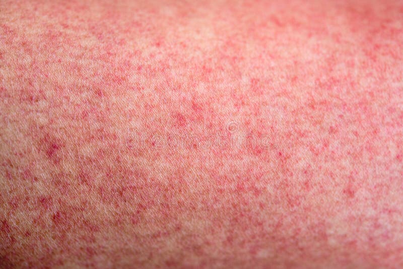 Pelle con le eruzioni di rosso delle dengue fotografia stock Pelle con le eruzioni di rosso delle dengue fotografia stock