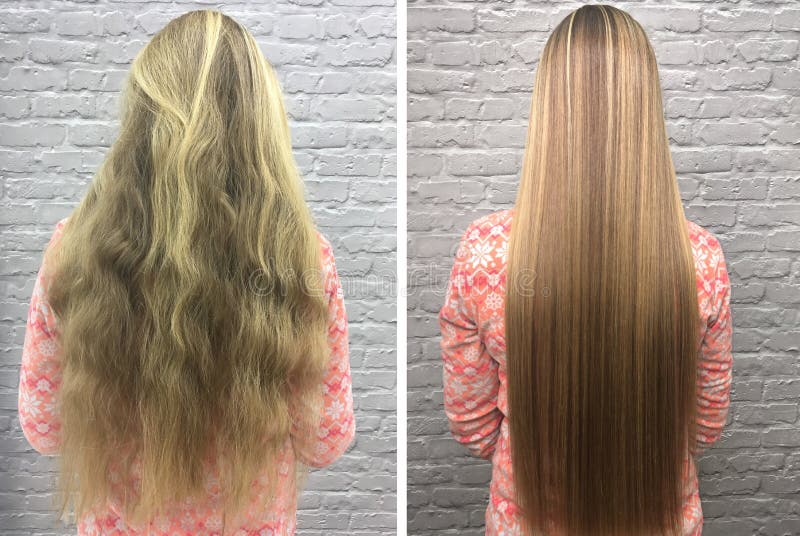 Mesoterapia Capelli Prima E Dopo Pelo Antes Y Después Del Tratamiento Imagen de archivo - Imagen de