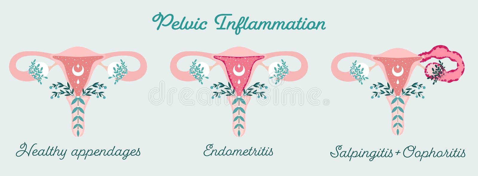 Salpingitis. Inflammation Of The Fallopian Tube. Oophoritis. Inflammation  Of The Ovary. Pelvic Organs. Infographics. Vector Illustration On Isolated  Background. Royalty Free SVG, Cliparts, Vectors, and Stock Illustration.  Image 68281130.