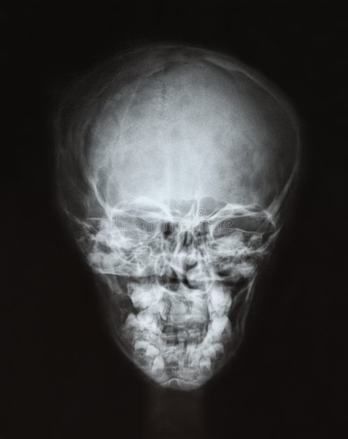 PelÃcula de rayos X del cráneo x27;s del niño foto de archivo PelÃcula de rayos X del cráneo x27;s del niño foto de archivo