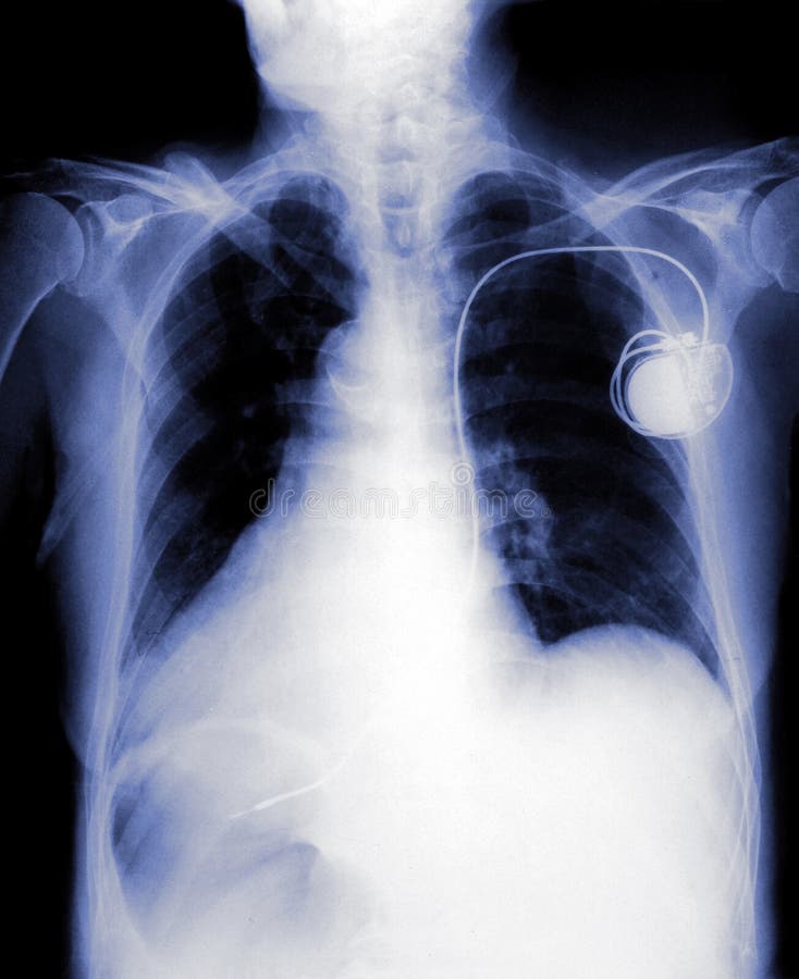 Pecho X Ray Con El Fabricante De Paso Imagen de archivo Imagen de