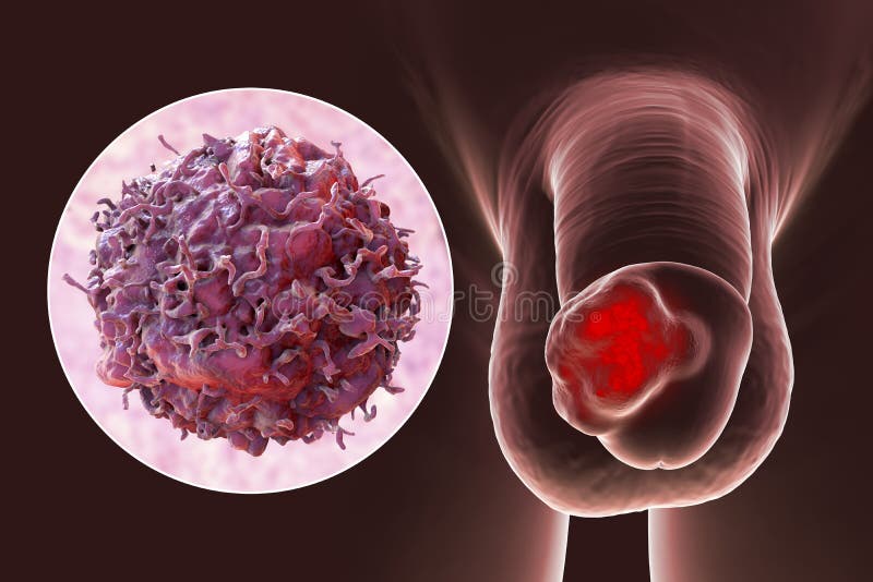 Arrangement financiën bloemblad Peniskanker 3d Afbeelding Van Maligne Tumor Op De Menselijke Penis Stock Illustratie - Illustration of microscopisch, kanker: 227950268 Arrangement financiën bloemblad Peniskanker 3d Afbeelding Van Maligne Tumor Op De Menselijke Penis Stock Illustratie - Illustration of microscopisch, kanker: 227950268