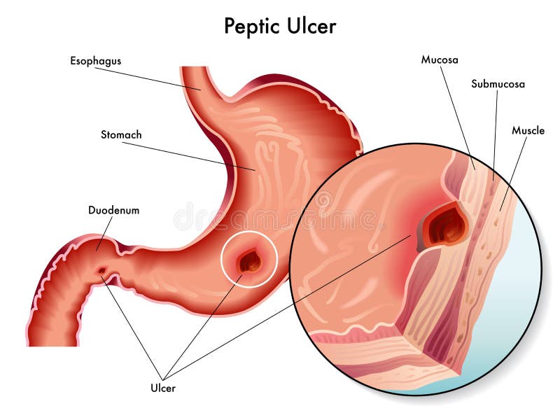 Peptic ulcer royalty free illustration Peptic ulcer royalty free illustration
