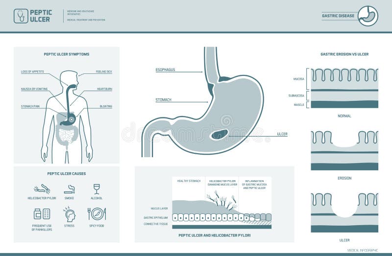 Péptico úlcera a síntomas a causas, cruz sección, médico ilustraciones.