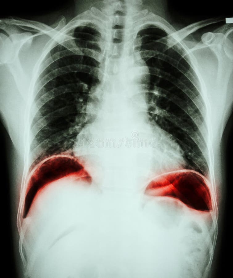 Peptic ulcer perforate