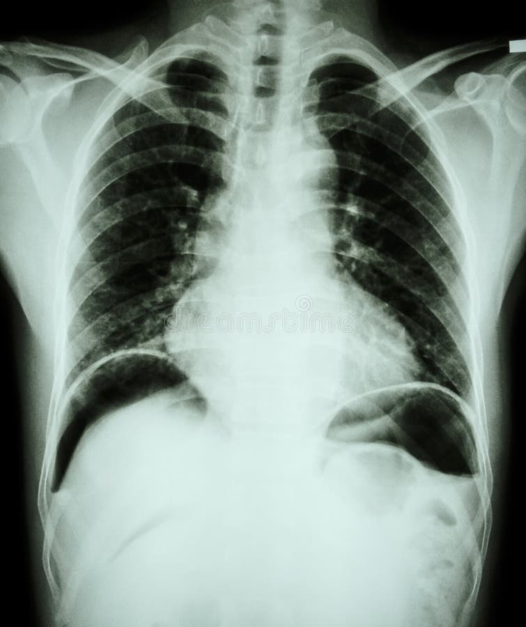 Peptic ulcer perforate . ( film chest x-ray show free air under dome of both diaphragm due to air leak from gastric ulcer or