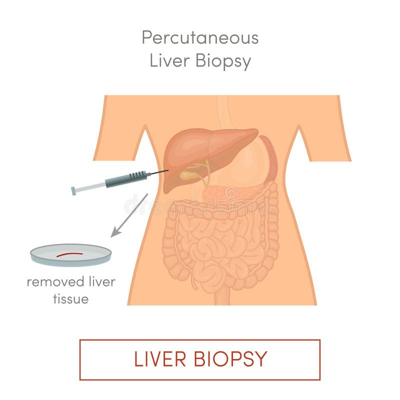 Percutaneous liver biopsy