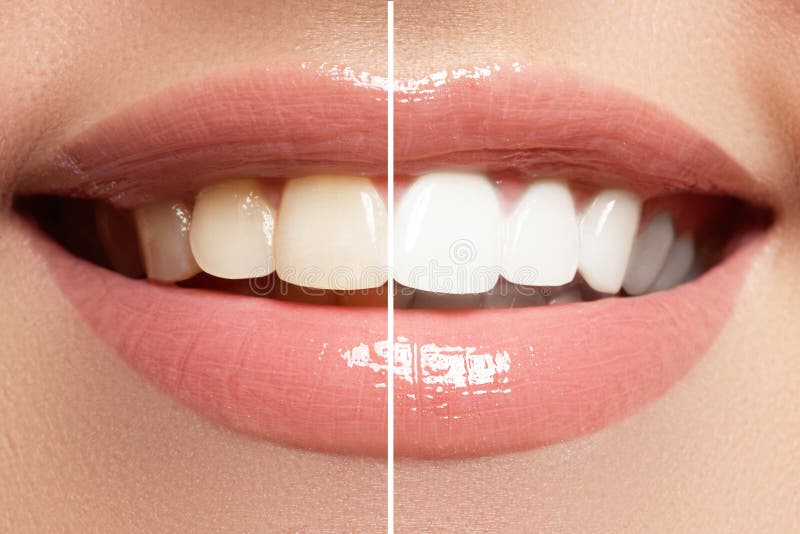 Perfecte glimlach before and after bleken Tandzorg en het witten van tanden