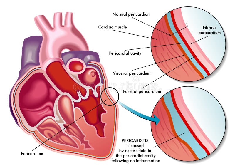 Medical illustration of the symptoms of pericarditis