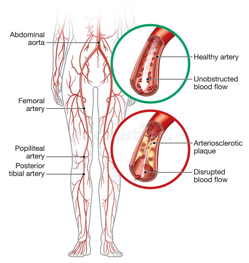 Perifere arteriële occlusieve aandoening intermitterende claudicatie medische illustratie