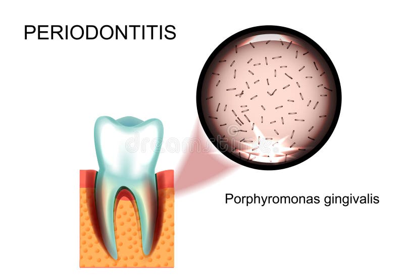 Periodontitis Gingivalis de Porphyromonas ilustração royalty free Periodontitis Gingivalis de Porphyromonas ilustração royalty free