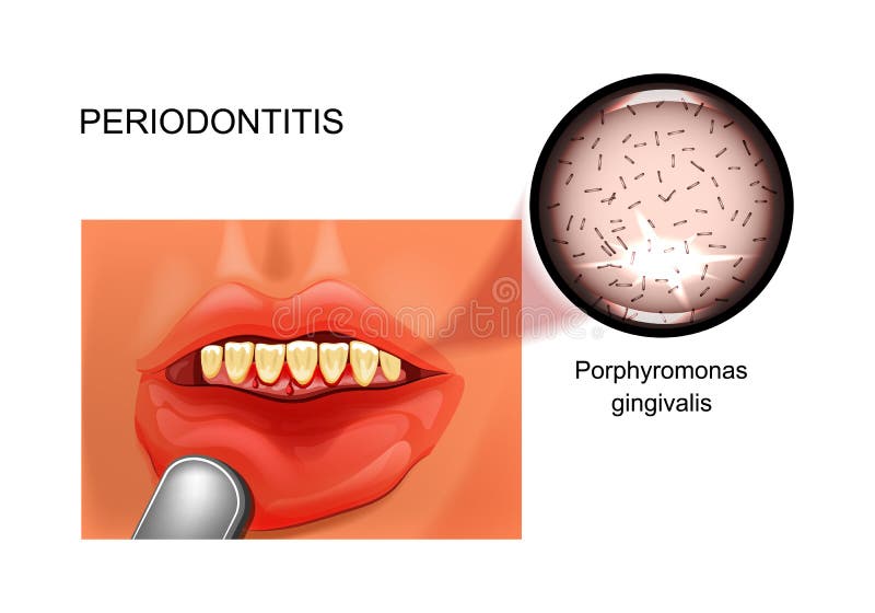 Vector illustration of periodontitis. bleeding gums. stomatology. Vector illustration of periodontitis. bleeding gums. stomatology