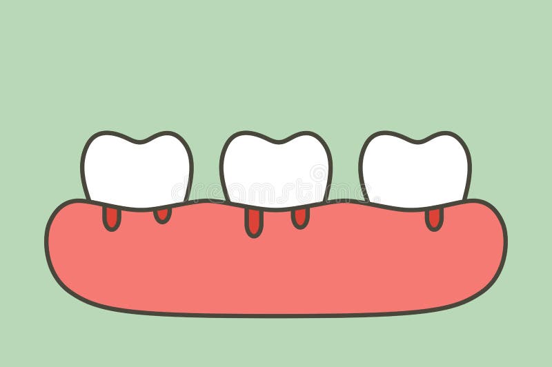 Periodontitis or gum disease with bleeding blood flow come from gum and tooth , dental problem stock illustration