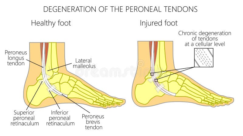 Vector illustration of Peroneal Tendon Injuries. Degeneration of the peroneus longus and brevis tendons. Tendinosis or tendinopathy. Lateral ankle injury. Vector illustration of Peroneal Tendon Injuries. Degeneration of the peroneus longus and brevis tendons. Tendinosis or tendinopathy. Lateral ankle injury.