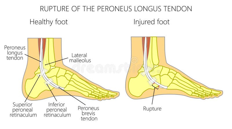 Vector illustration of Peroneal Tendon Injuries. Rupture of the peroneus longus tendon. Lateral ankle injury. Vector illustration of Peroneal Tendon Injuries. Rupture of the peroneus longus tendon. Lateral ankle injury.