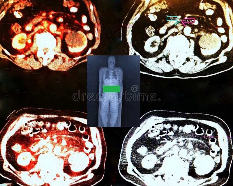 Pet/ct nuclear medicine very specific exam, radiopharmaceutical must be injected in right time during short time after production of isotope ,every slice is very important from scull to pelvis ,correct diagnose the most important result of this exam green level indicate frames with renal tumor pet/ct exam in medicine possible only in medical centers, which has ability to get nuclear medicine FDG18 radiopharmaceutical in time, due to very short time of 1/2 life of isotope , result of this exam images of every level of the body ,and for doctor one more chance make right conclusion. Pet/ct nuclear medicine very specific exam, radiopharmaceutical must be injected in right time during short time after production of isotope ,every slice is very important from scull to pelvis ,correct diagnose the most important result of this exam green level indicate frames with renal tumor pet/ct exam in medicine possible only in medical centers, which has ability to get nuclear medicine FDG18 radiopharmaceutical in time, due to very short time of 1/2 life of isotope , result of this exam images of every level of the body ,and for doctor one more chance make right conclusion