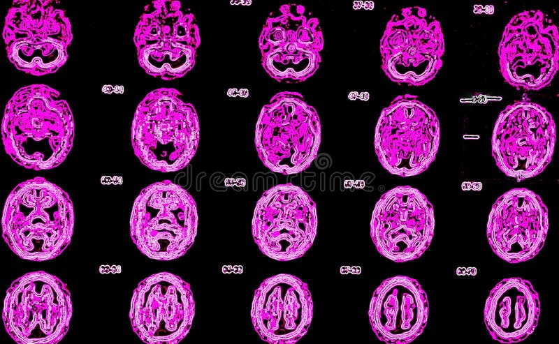 Pet / ct di medicina nucleare molto specifico esame, radiofarmaco deve essere iniettato nel momento giusto durante il breve periodo di tempo dopo la produzione di isotopi , ogni fetta è molto importante dal cranio di bacino , la corretta diagnosi il più importante risultato di questo esame, ci sono una serie di cervello esame.