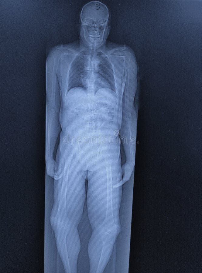 pet/ct del cuerpo entero imagen de archivo libre de regalías pet/ct del cuerpo entero imagen de archivo libre de regalías