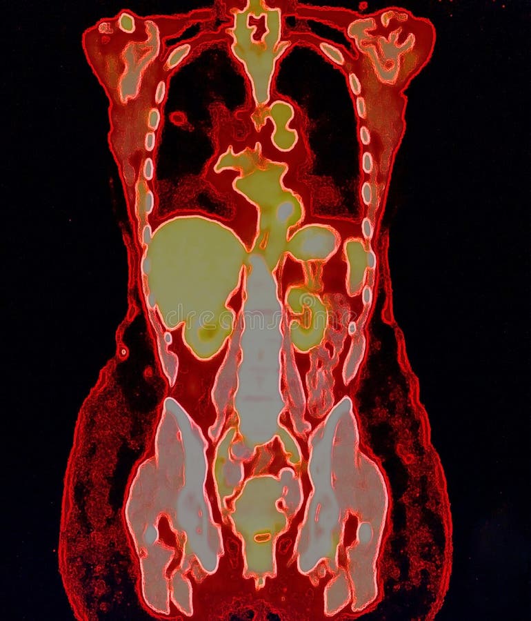 Pet/ct of lung cancer