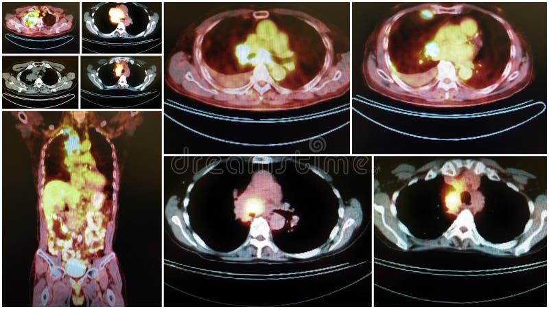 Pet ct tumor mediastinum and lung collage