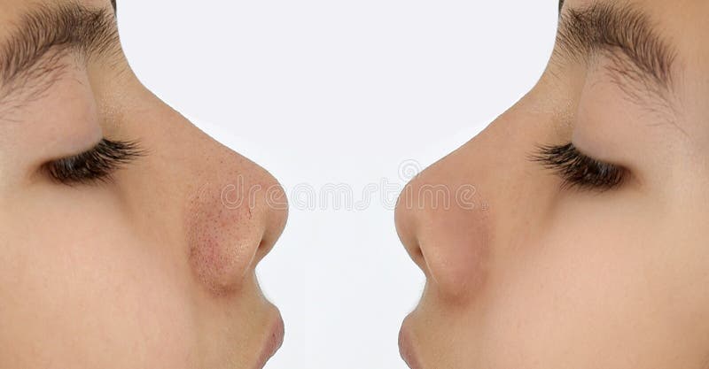 Photo fermer avant et après le traitement petits boutons acné noires sur la peau du nez adolescent. problème soins de la peau et s photos stock
