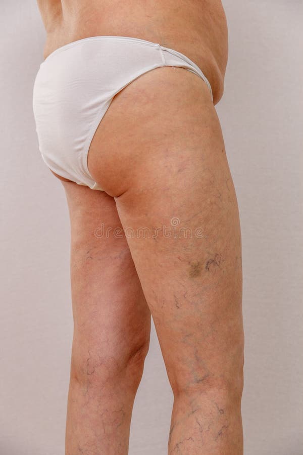 Photo of the Legs and Buttocks of an Old Woman in White Panties with  Cellulite and Varicose Veins on a Light Background. Stock Photo - Image of  body, adult: 131570222