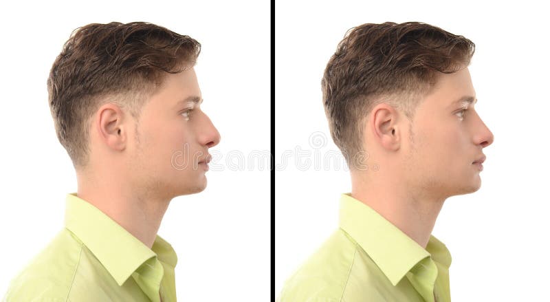 Before and after photos of a young man with nose job plastic surgery. royalty free stock photos Before and after photos of a young man with nose job plastic surgery. royalty free stock photos