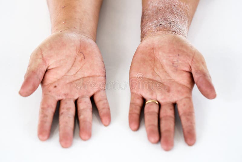 Atopic Dermatitis AD, Also Known As Atopic Eczema, is a Type of