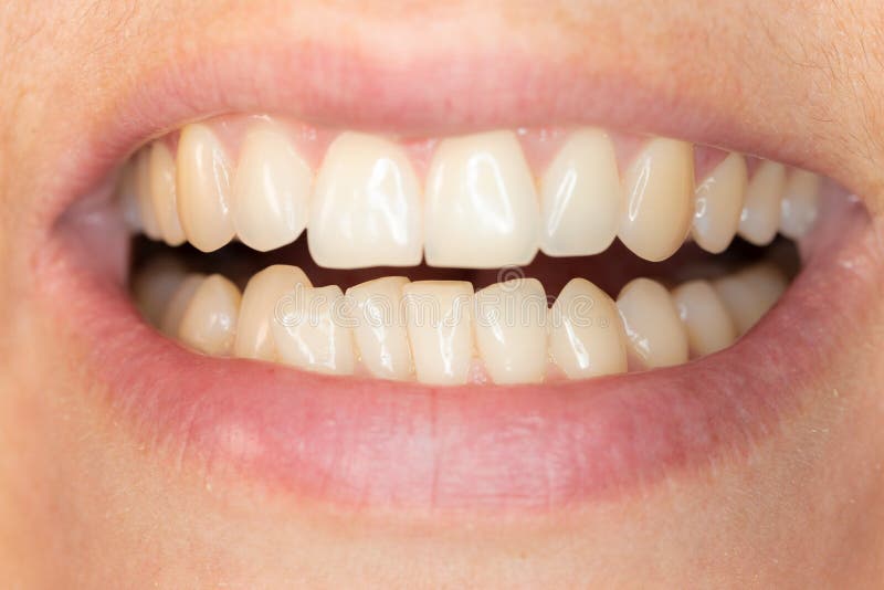 Crowding of the Teeth of the Lower Jaw of a Young Caucasian Man Stock