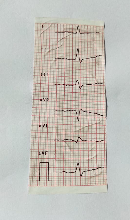 Piece of ECG paper, medical care for heart failure patients, showing normal sinus rhythm.