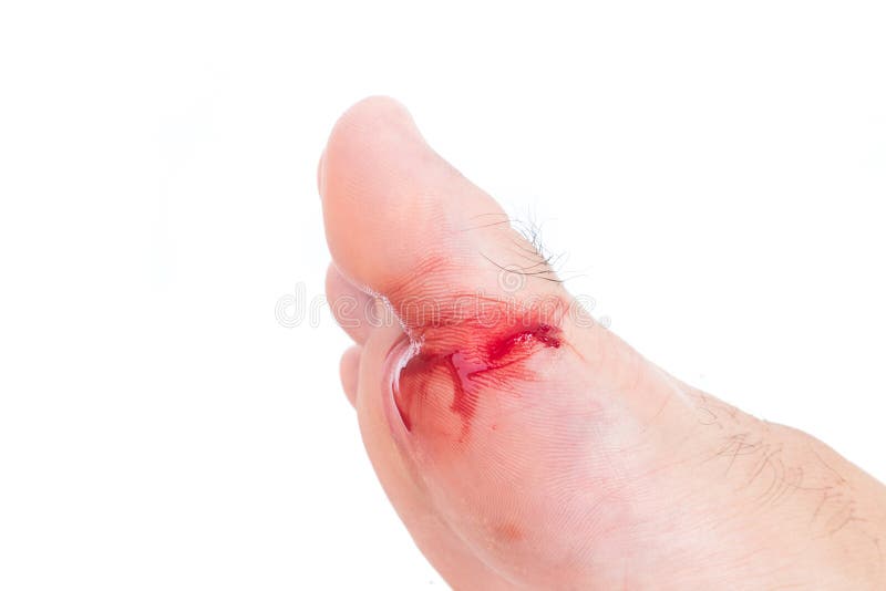 Pied blessé, blessure fraîche et sang du verre cassé, CCB blanc image stock Pied blessé, blessure fraîche et sang du verre cassé, CCB blanc image stock