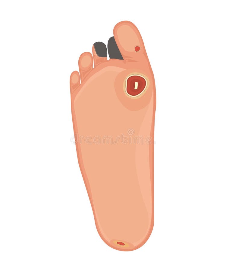 Pied Diabétique Ischémie Et Neuropathie Illustration de Vecteur Illustration du maïs, ampoule