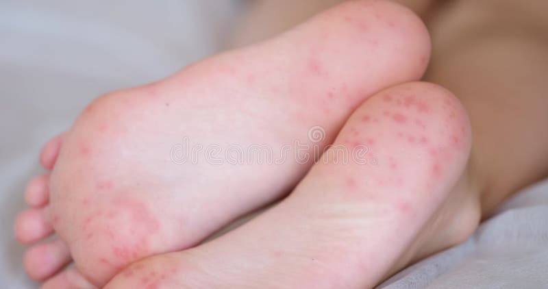 Pieds d'enfant avec taches allergiques rouges points à pied