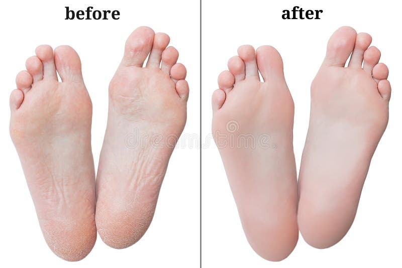 Pieds de femmes avant et après l'épluchage image libre de droits Pieds de femmes avant et après l'épluchage image libre de droits